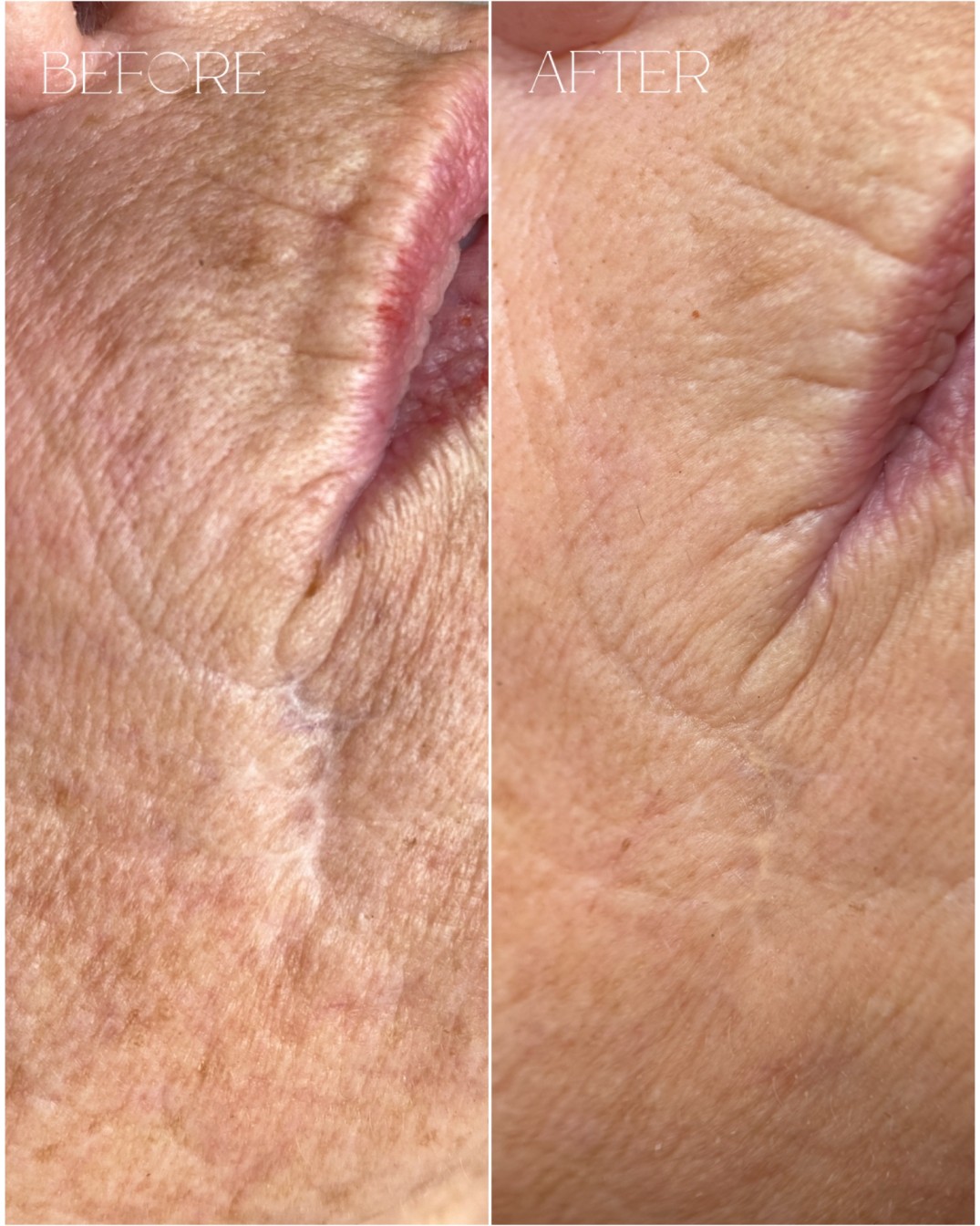 Facial scar camouflage permanent makeup before and after Sterling VA