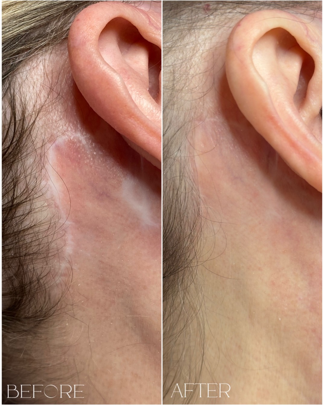 Scar lightening and skin camouflage permanent makeup Re:Pigment.Me