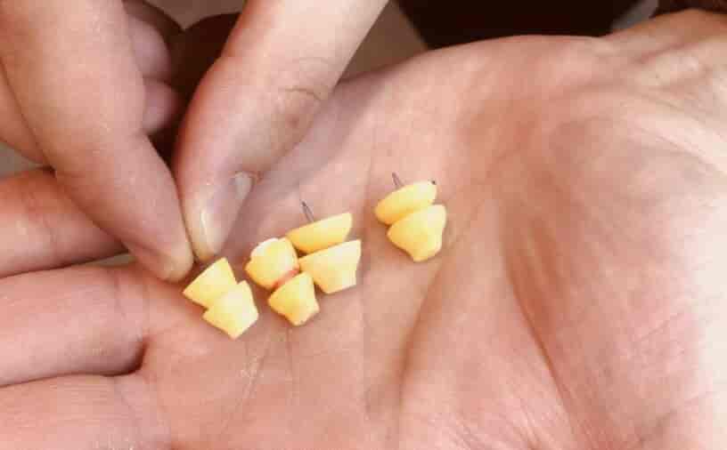 Das Phonak Lyric gehört mit zu den kleinsten Hörgeräten, die es gibt. Im Gegensatz zu allen anderen Hörgeräten, die im Ohr getragen werden, verschwindet das Lyric Hörgerät so tief im Gehörgang, dass es mit bloßem Augen nicht mehr zu sehen ist.