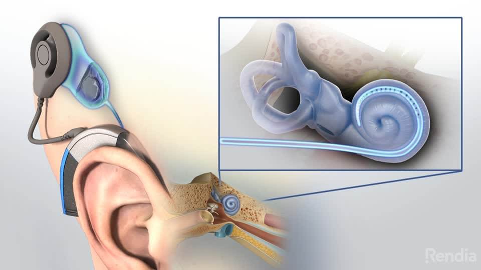 Insgesamt gibt es in Deutschland rund 5,4 Millionen Schwerhörige, aber nur 3,7 Millionen Betroffene trugen ein Hörgerät. Hörgeräte sind meist das einzige Hilfsmittel, das bei einer Schwerhörigkeit helfen kann