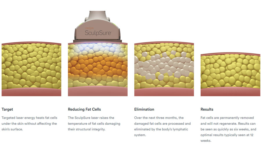 SculpSure treatment areas
