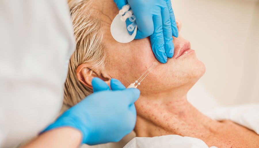 Lux Medical Spa PDO thread lift results