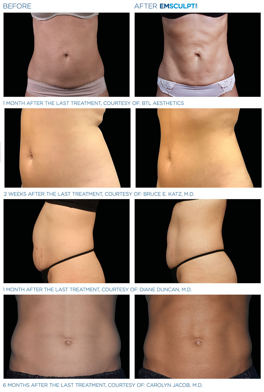 Experience EM SCULPT NEO at Lux Medical Spa, Irvine