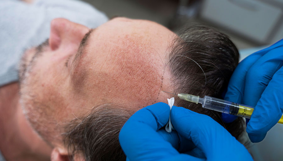 A patient delighted with the PRP Hair Restoration at Lux Medical Spa, Irvine