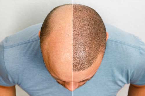 FUE Hair Transplant Graft Survival Science