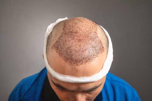 FUE Hair Transplant Follicular Transection