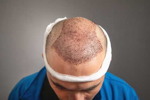 FUE Hair Transplant Follicular Transection