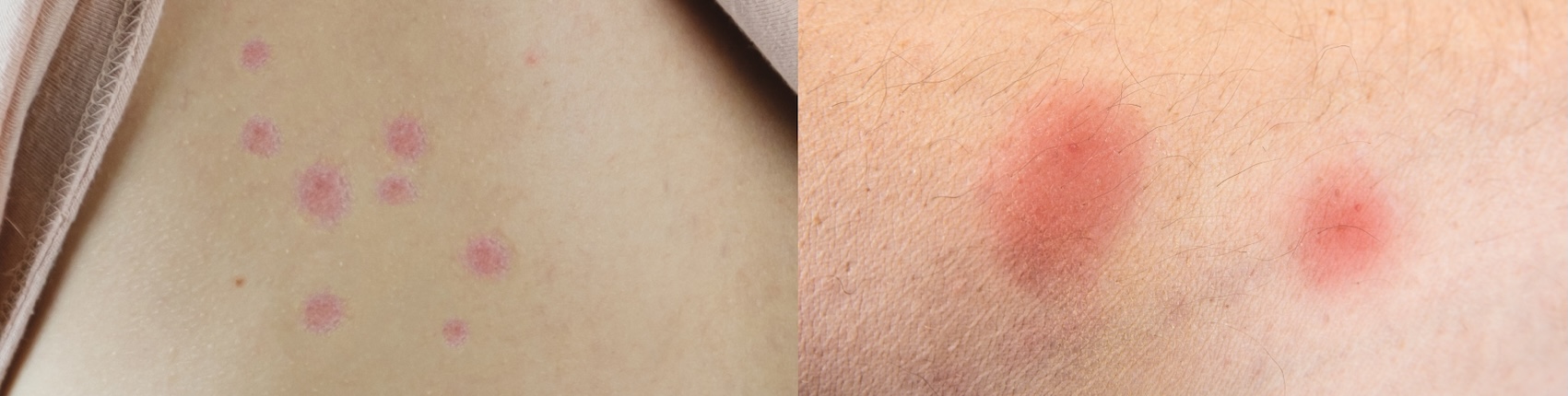 Nahaufnahme von Bettwanzenbissen am Körper