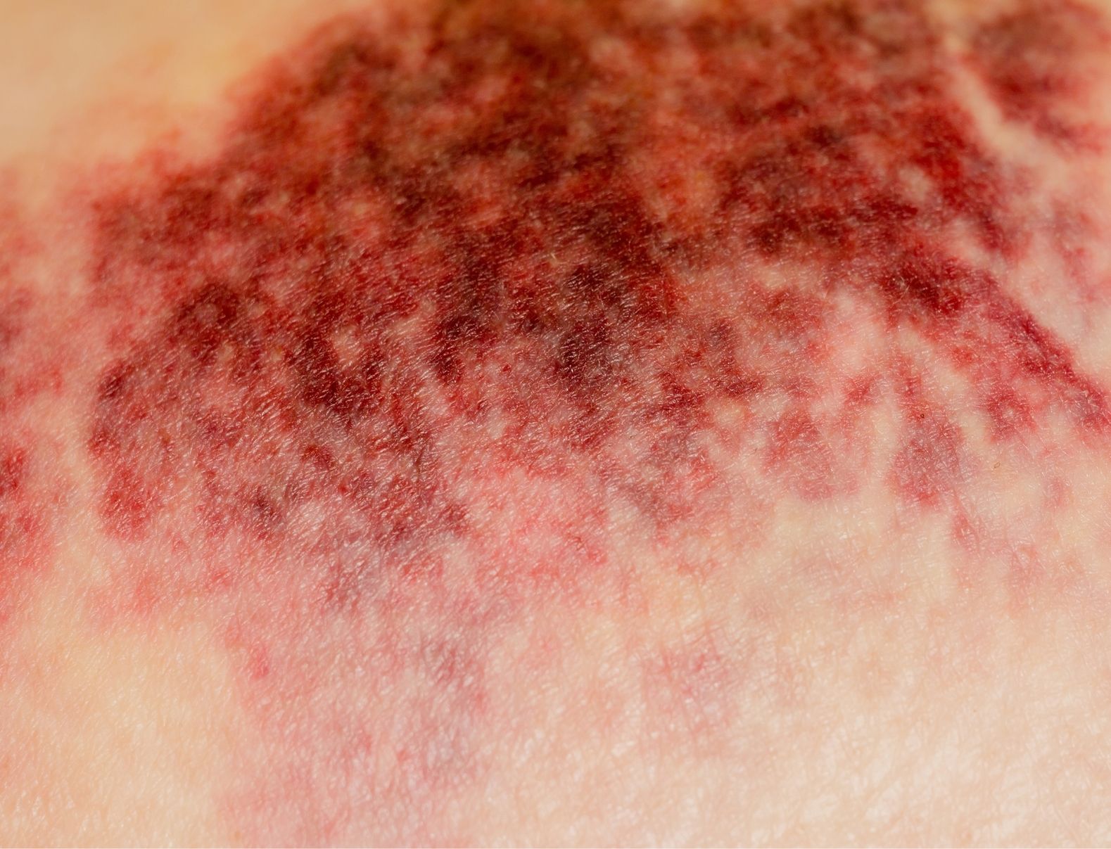 Dekubitus vermeiden – Matratzen, Lagerung und Alltagstipps