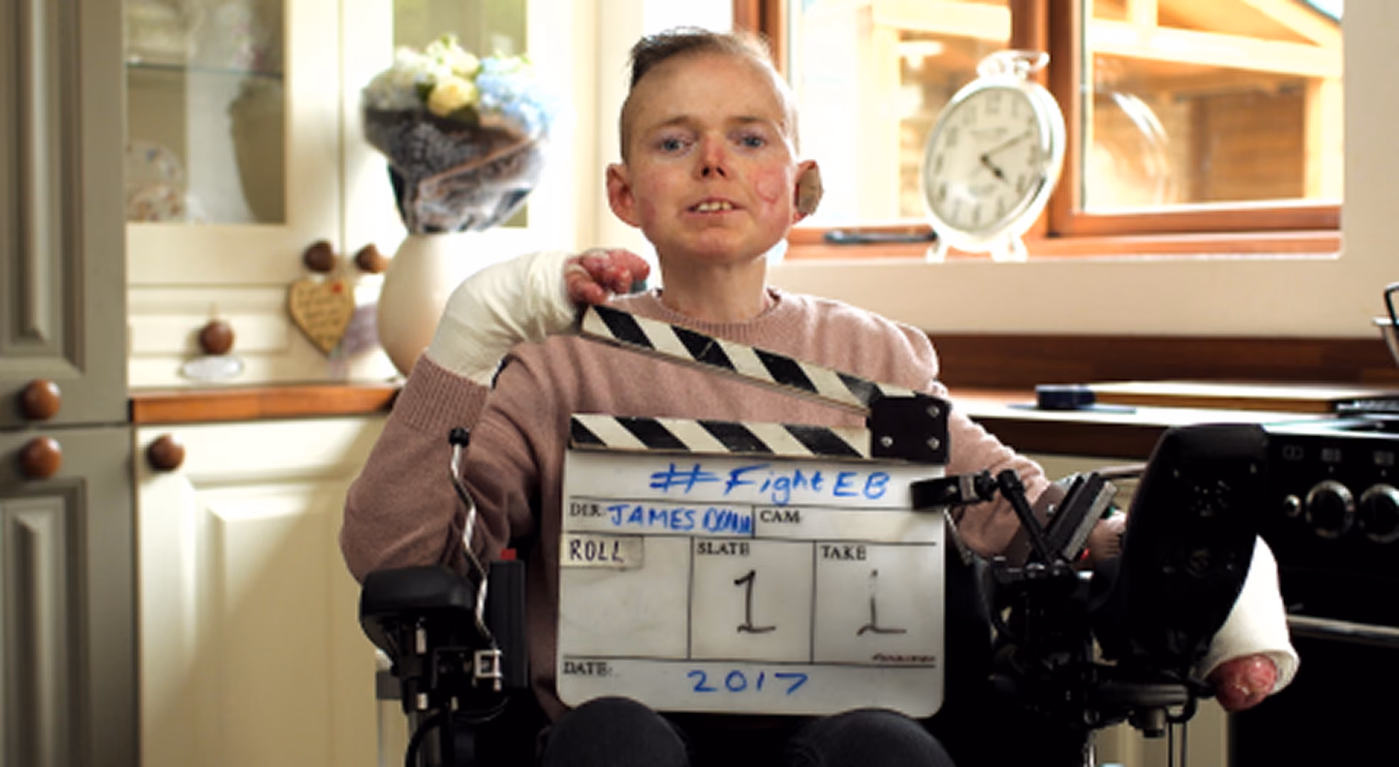 A young person with Epidermolysis Bullosa holding a clapperboard marked '#FightEB', from a DEBRA campaign