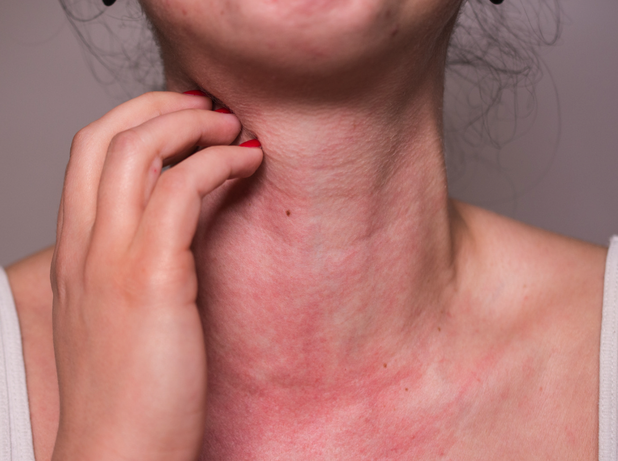 What If Histamine Isn't the Root Problem?