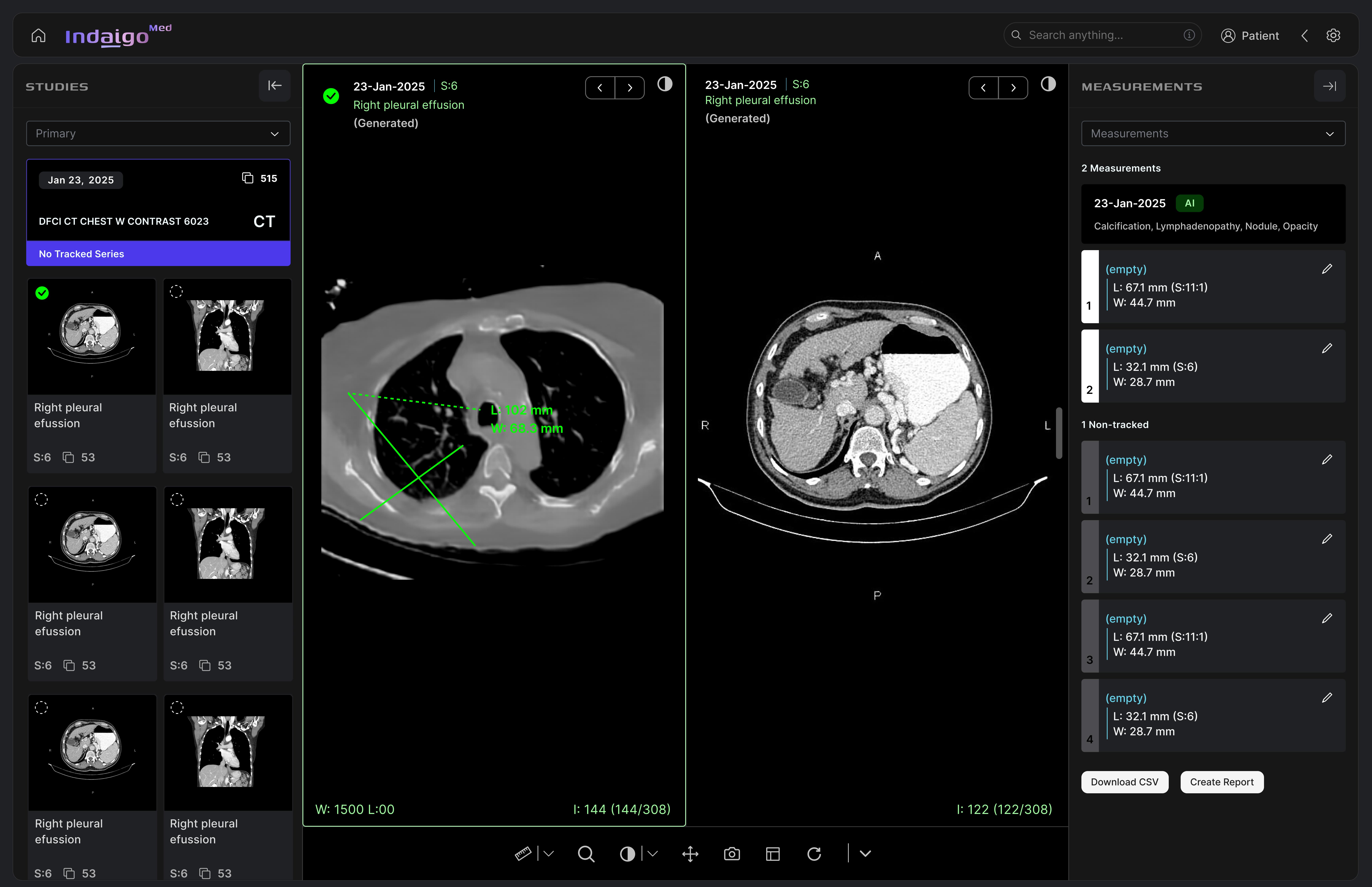 Indaigo medical imaging interface showing CT studies, AI-generated findings and measurements