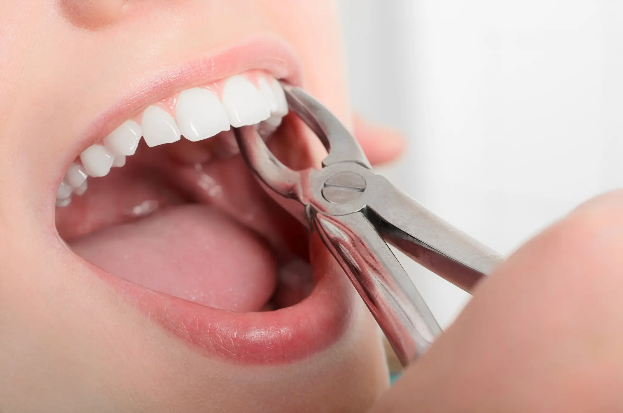 dental sealants near me
