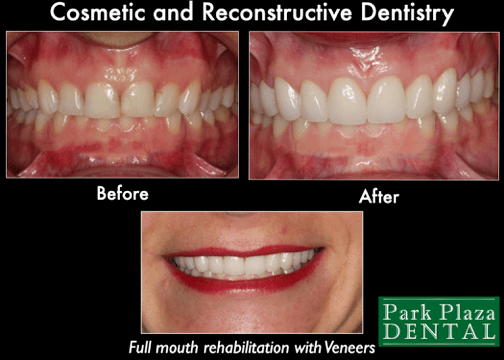 Full Mouth Restoration