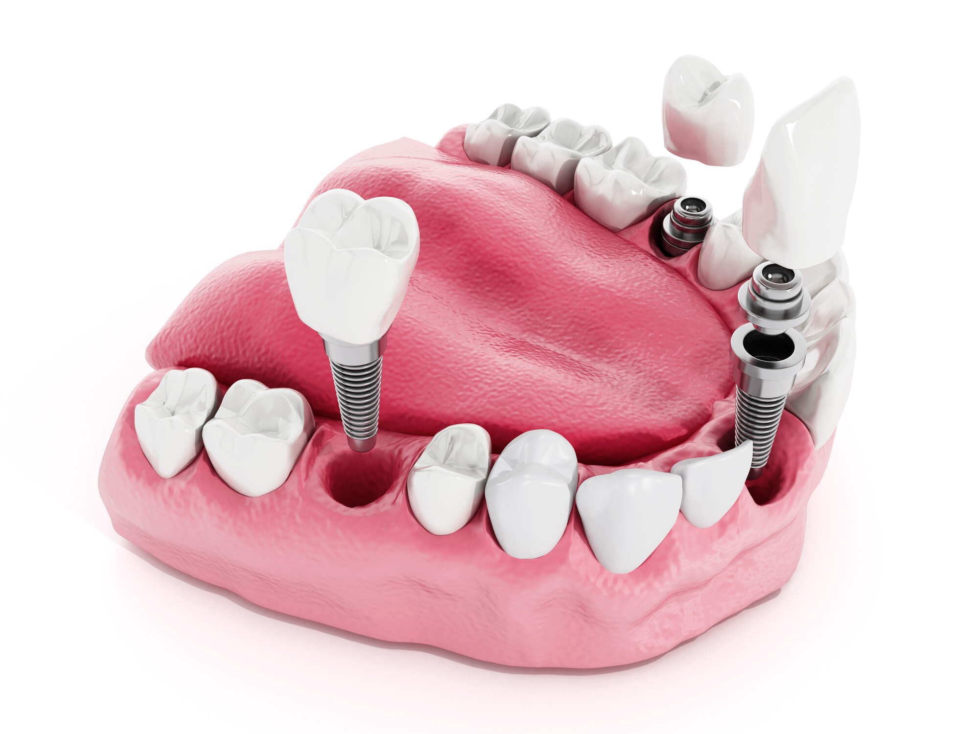 mouth showing Dental Implants Pompano Beach