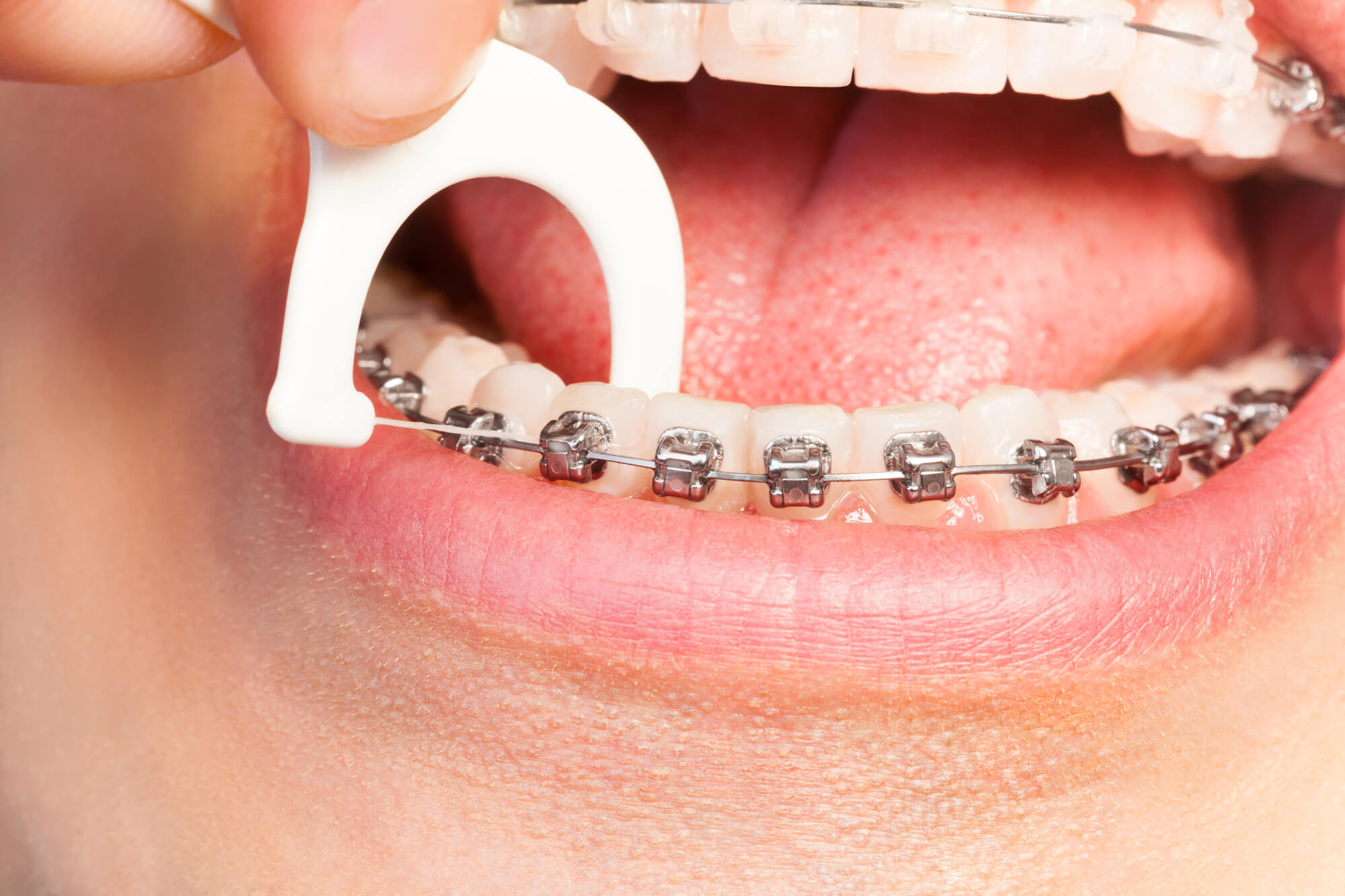 flossing while wearing Braces Pompano Beach