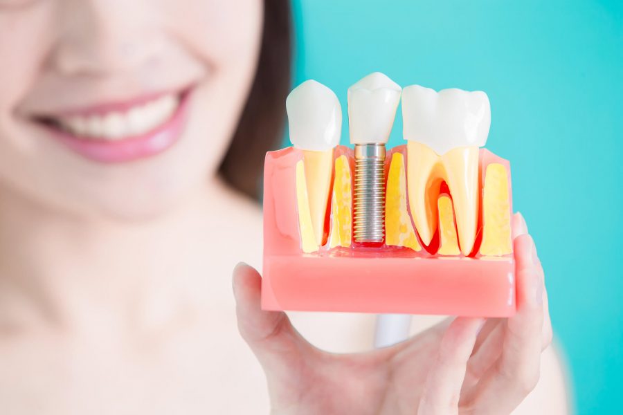 Dentist showing dental implants in Pompano Beach