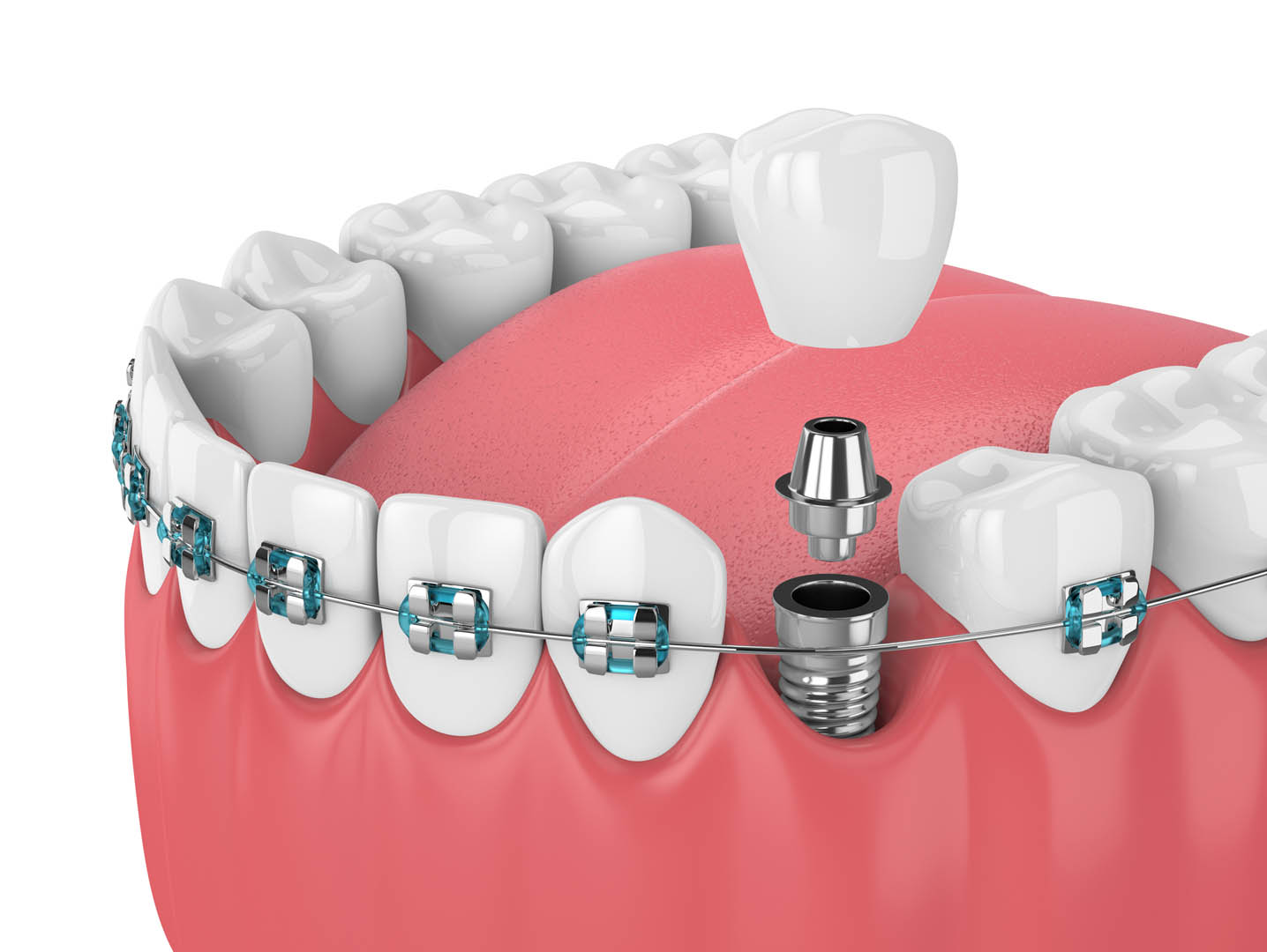 3D render of Dental Implants 33062