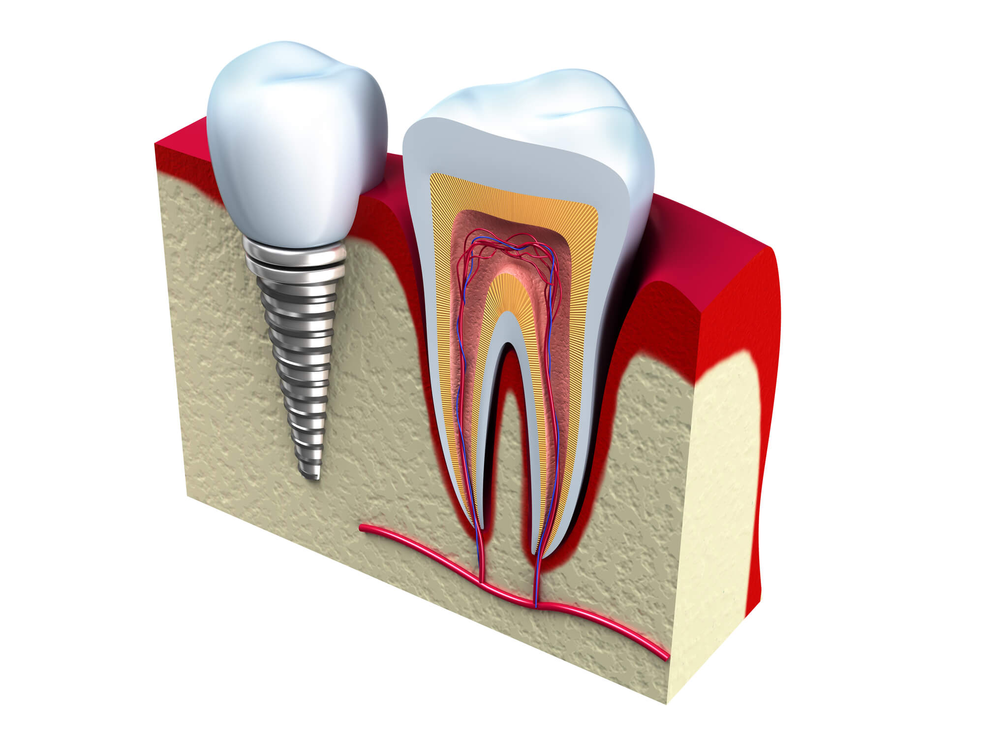 Dental Implants Pompano Beach and a natural tooth side by side