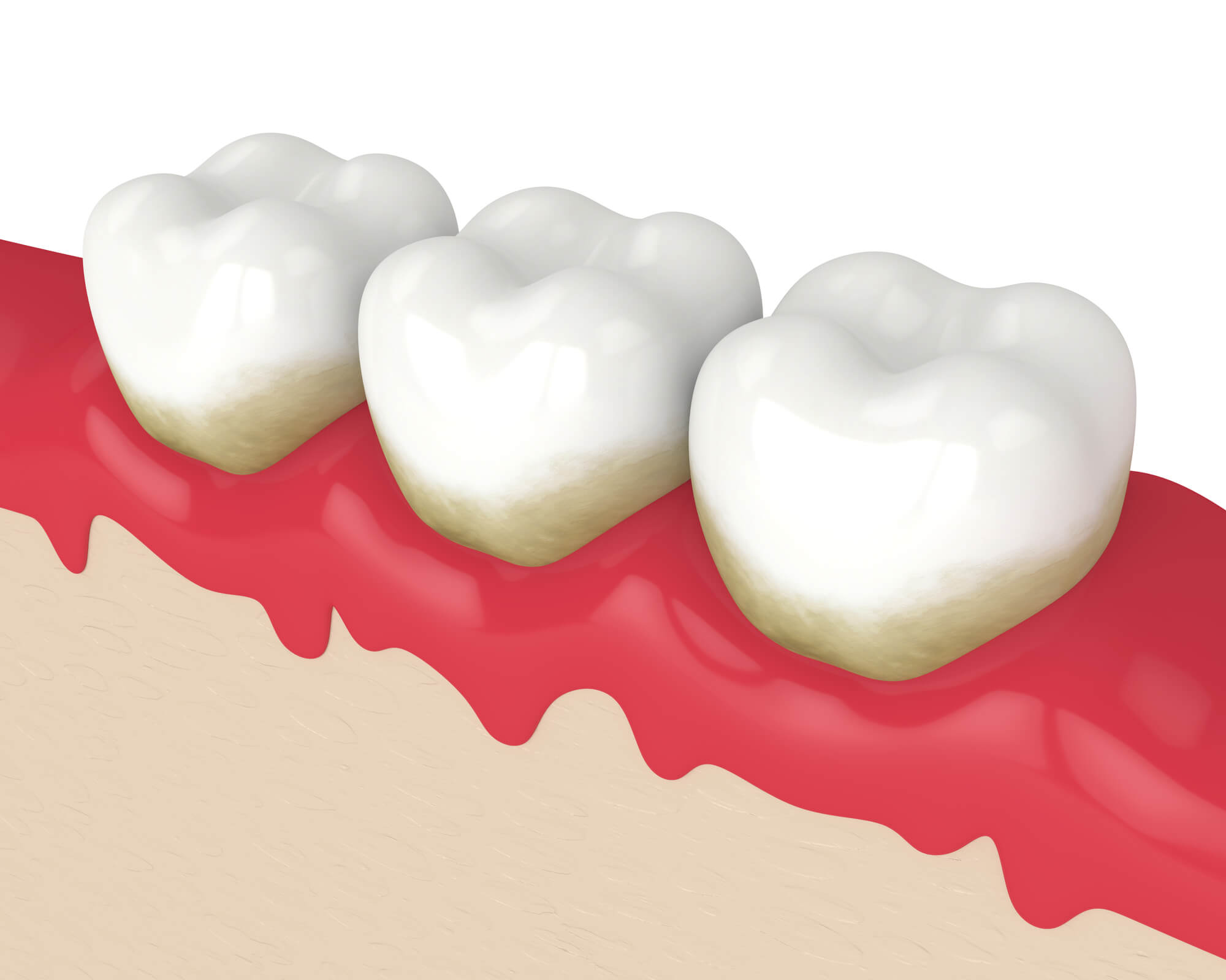 close up image of inflamed gum tissues