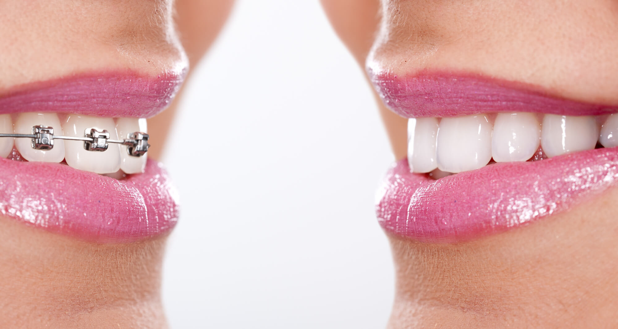 Before and after visiting Orthodontist 33062