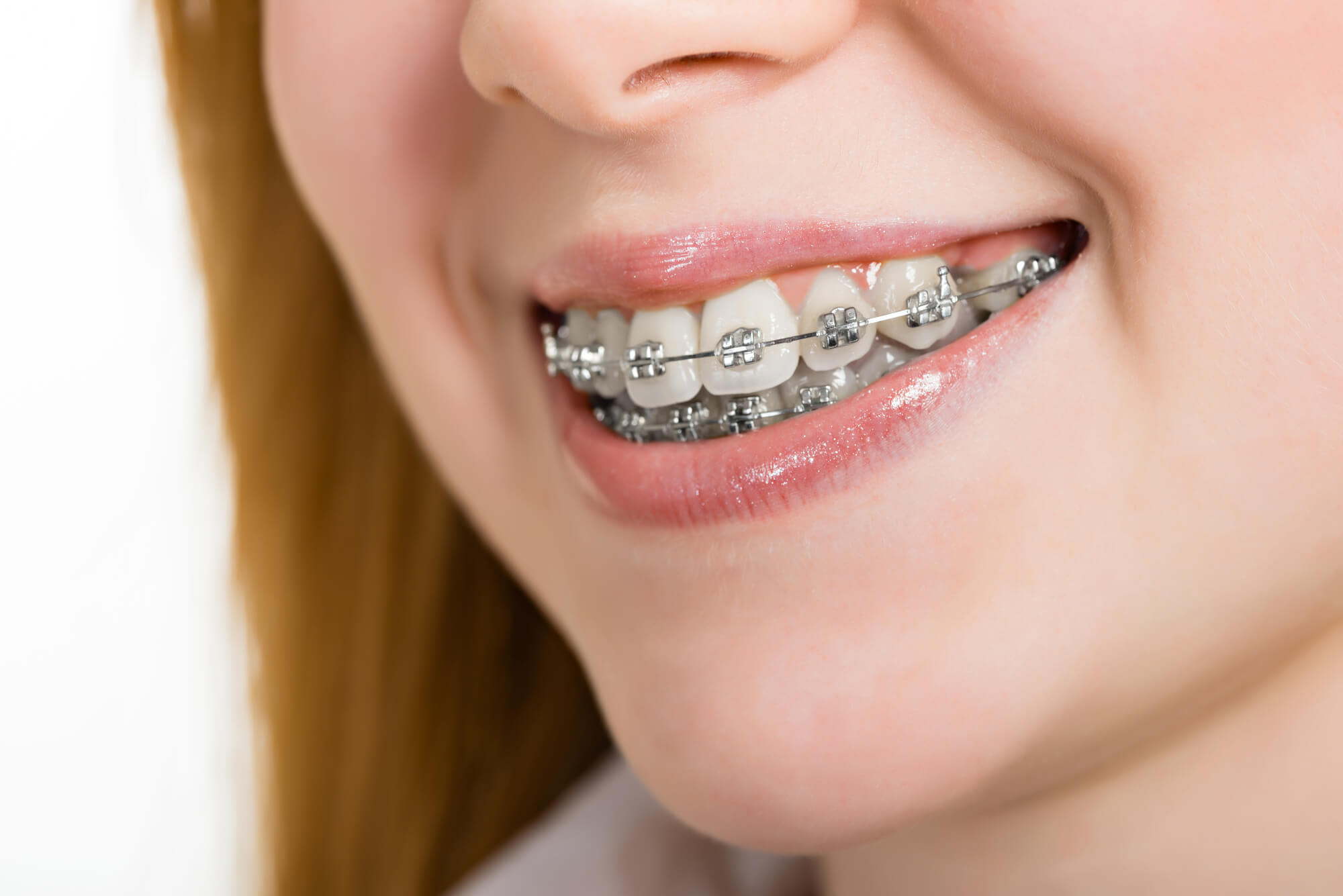 Braces in Pompano Beach