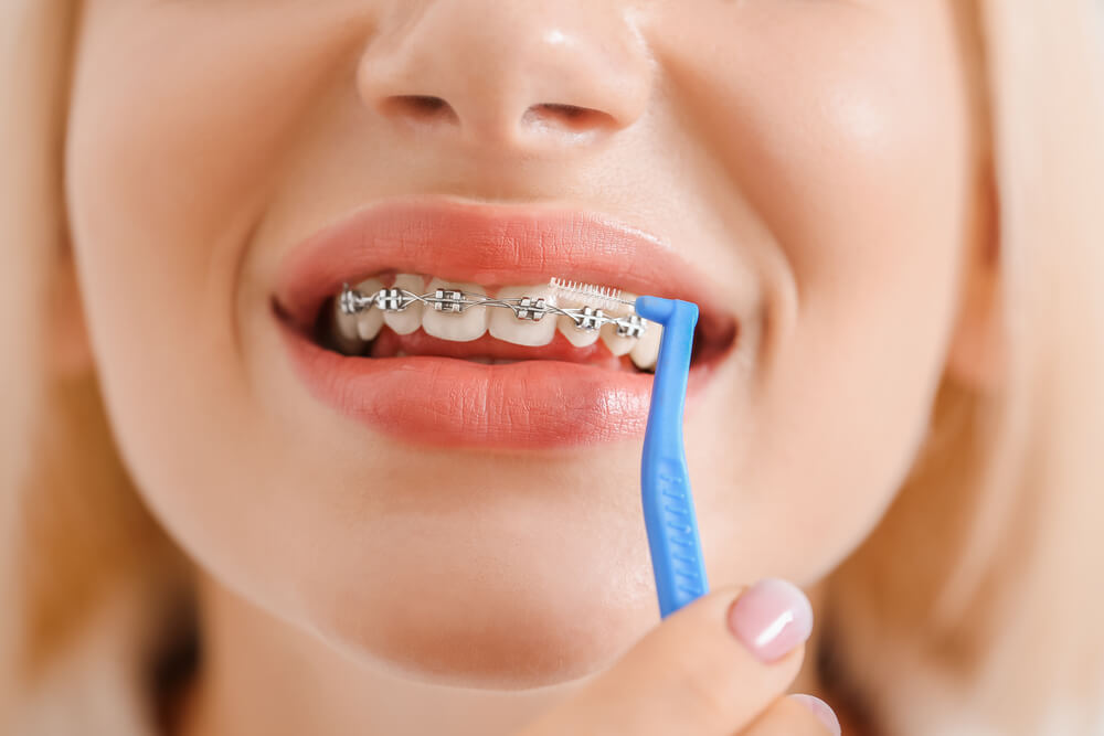 a woman uses the right tooothbrush to clean her Braces in Pompano Beach