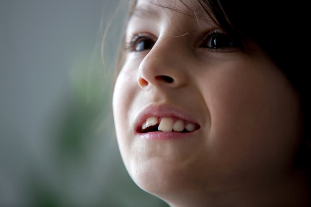 a child with crooked teeth needing to see an Orthodontist in 33062