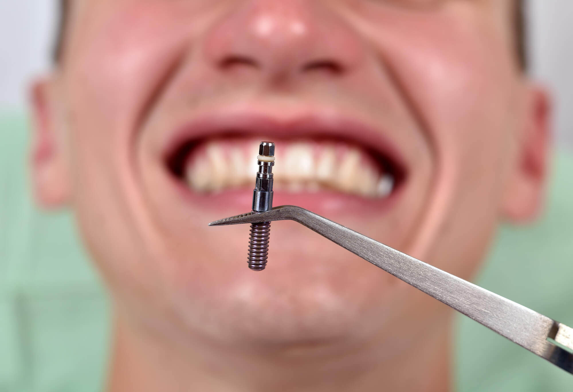 a dentist shows the patient one of the Dental Implants in 33062