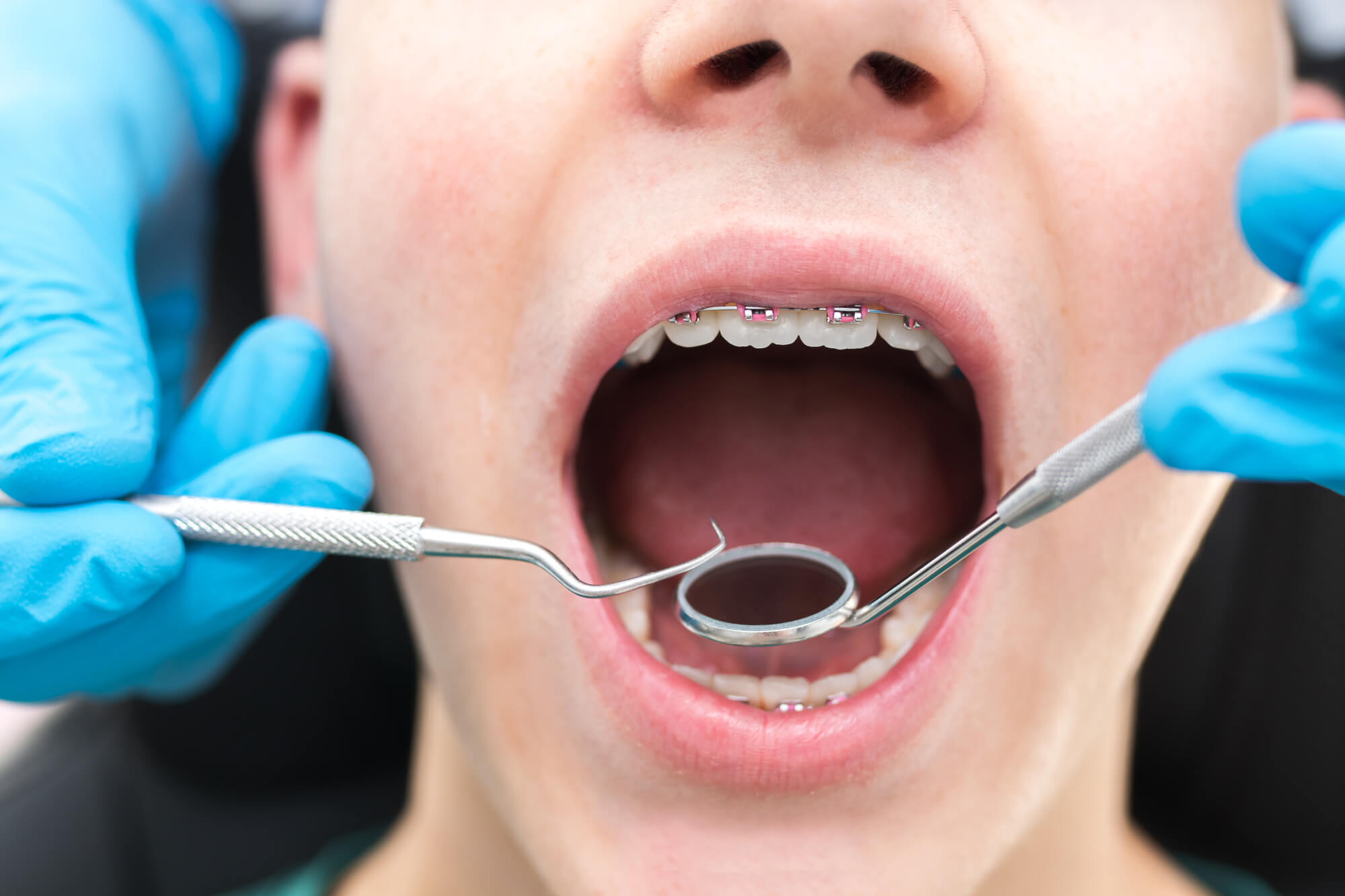 patient getting his Braces in Pompano Beach adjusted