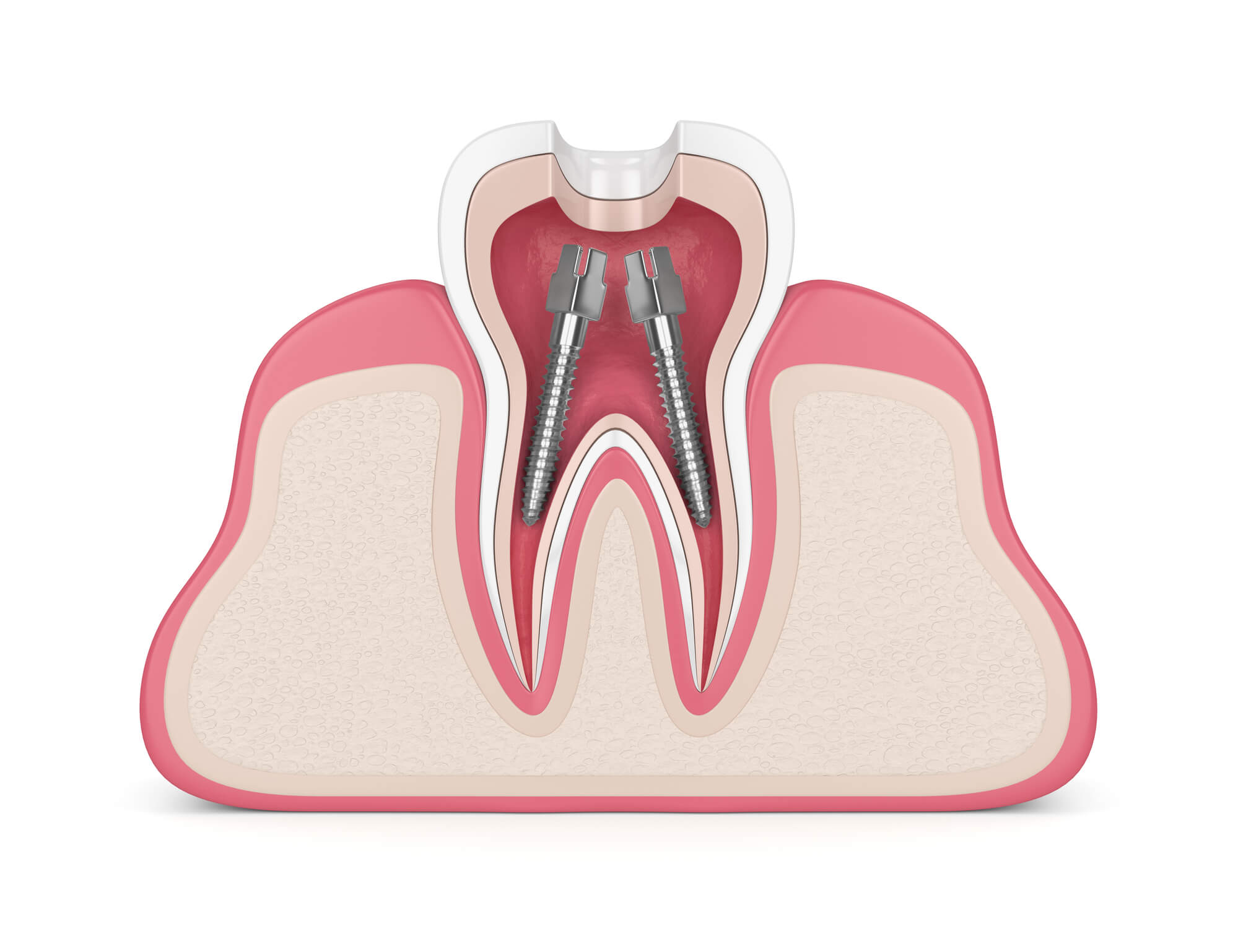 diagram of root canal in Pompano Beach