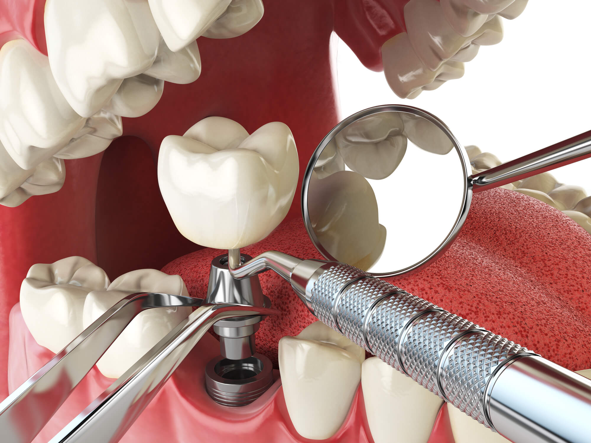 recreation of dental implants in 33062 getting placed