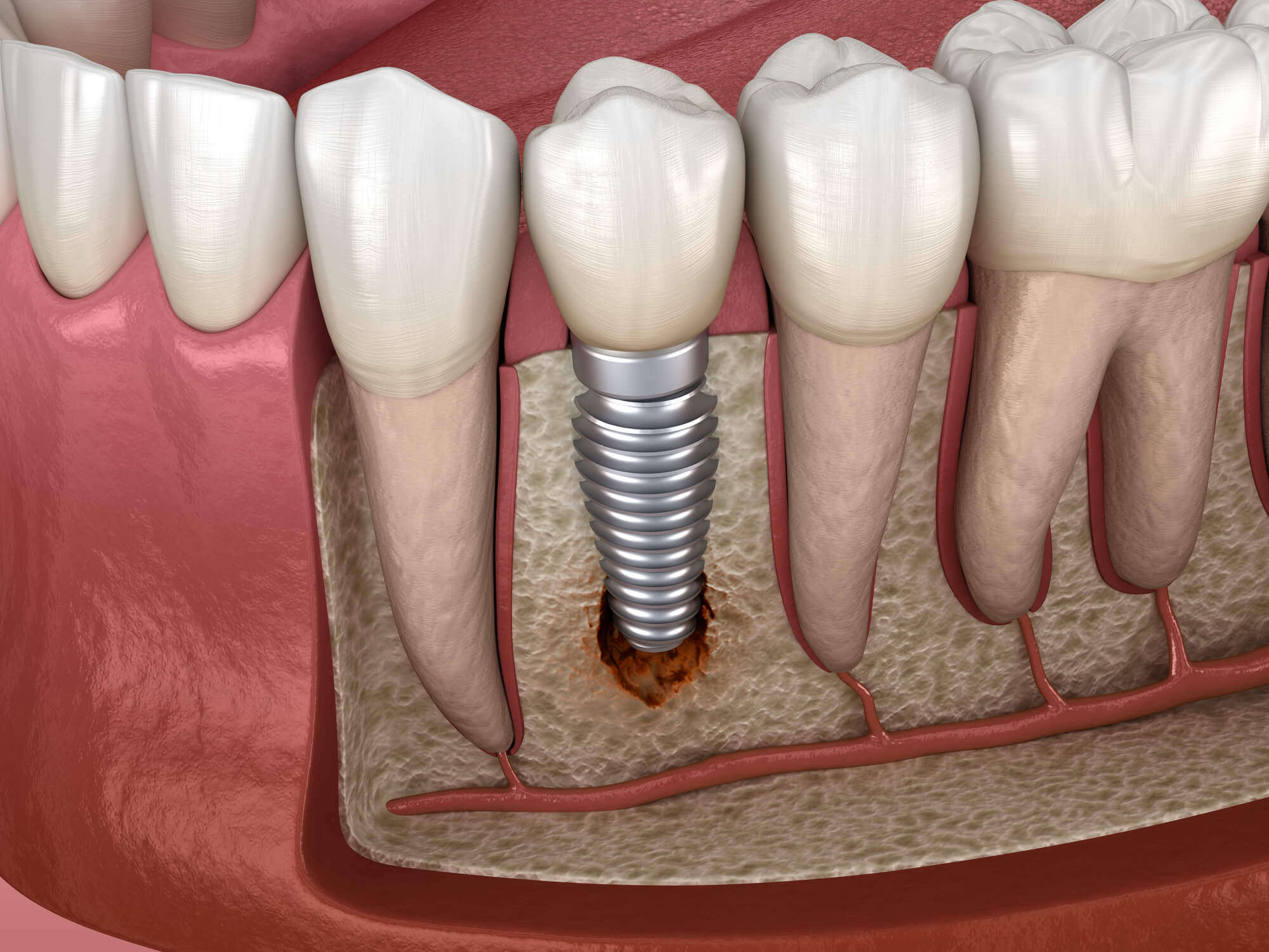 dental implants inside a mouth with damaged tissue in Pompano Beach