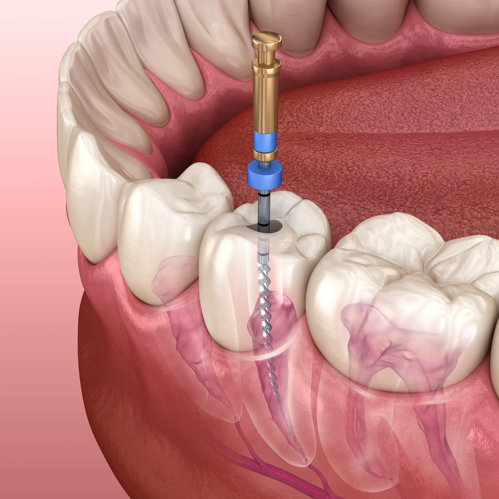 Root Canal Pompano Beach