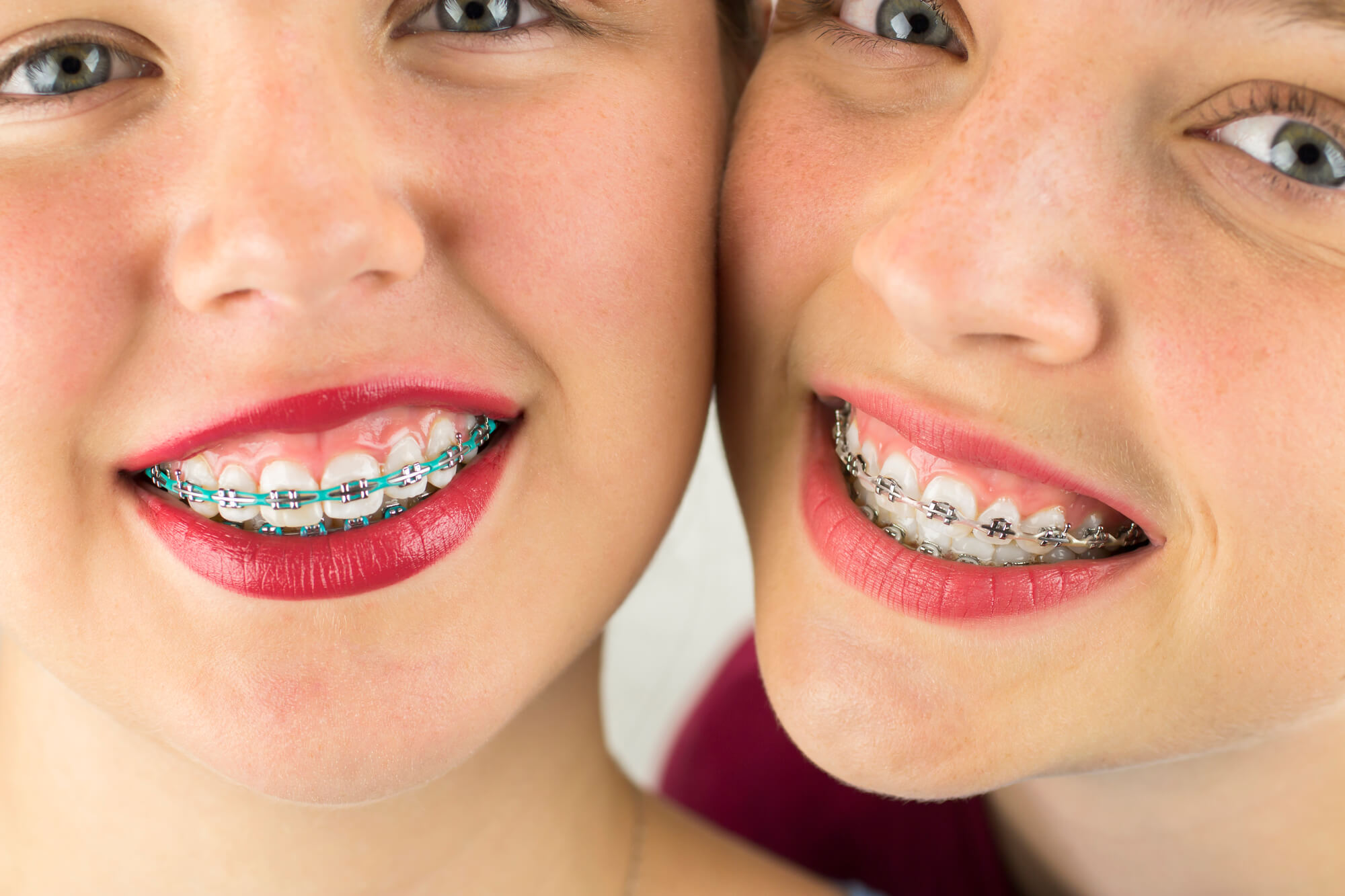 kids wearing braces in pompano beach