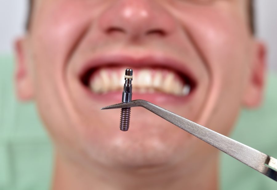 Illustration Dental Implants in Pompano Beach