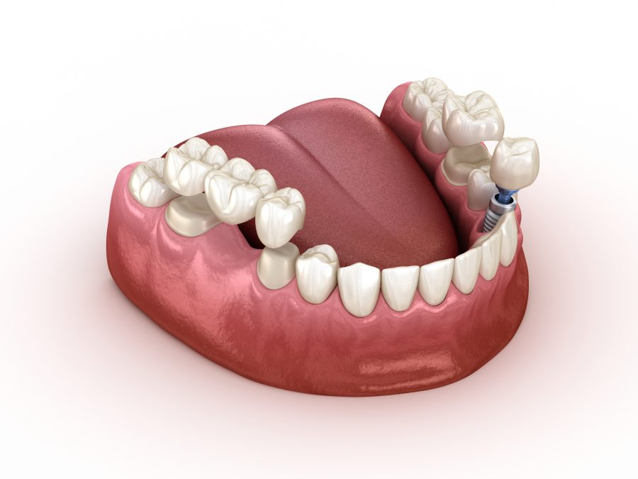 Sample of Dental Implants in Pompano Beach