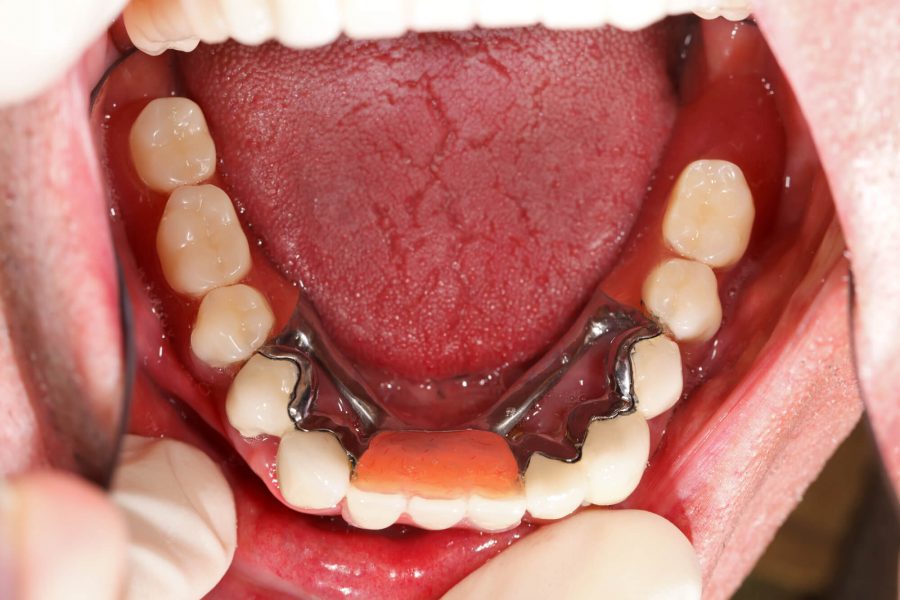 Dentures in Pompano Beach in mouth