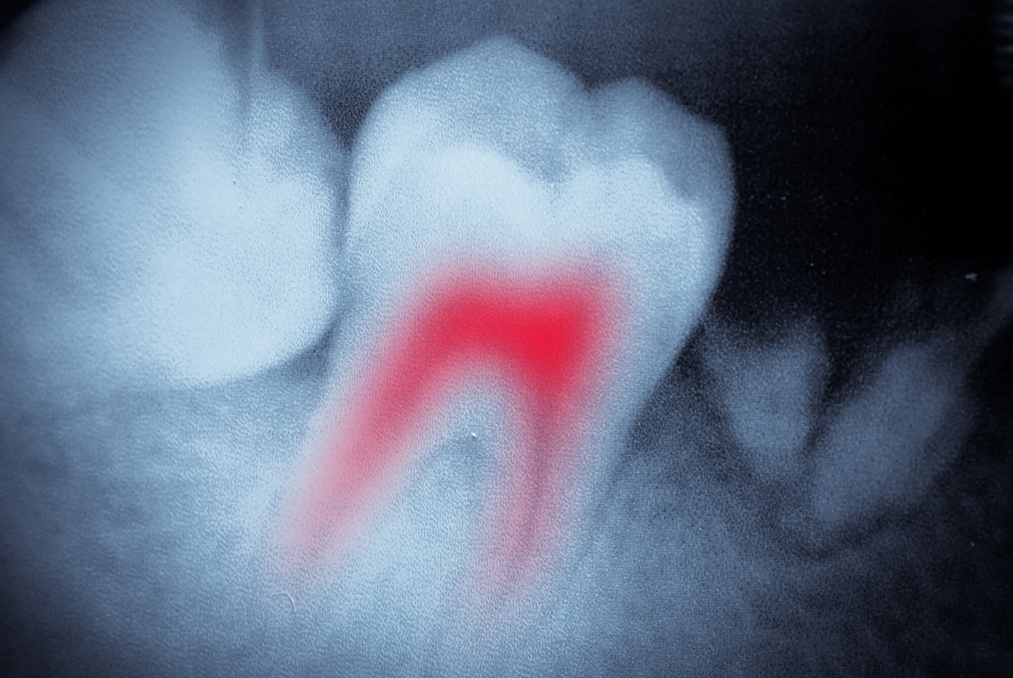 x ray of a tooth in need of root canal therapy in pompano beach