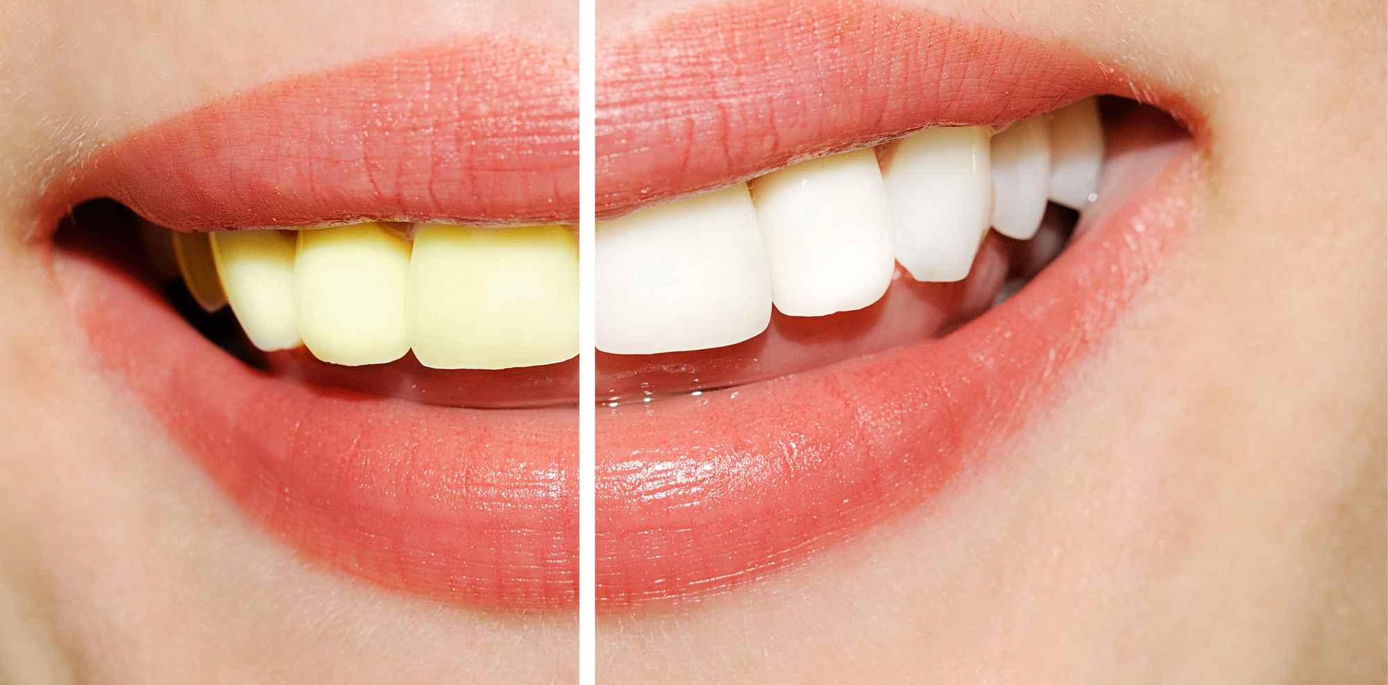 close up of a smile before and after teeth whitening in Pompano Beach
