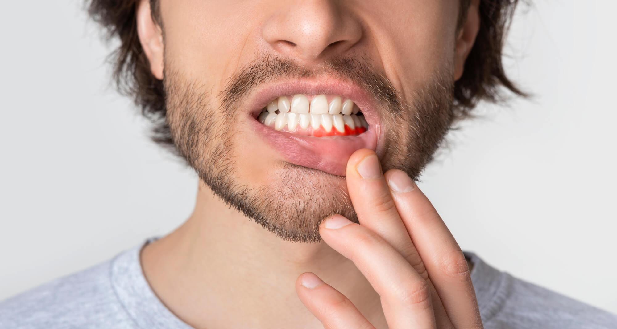 Man with swollen gums needs a Periodontist in Pompano Beach