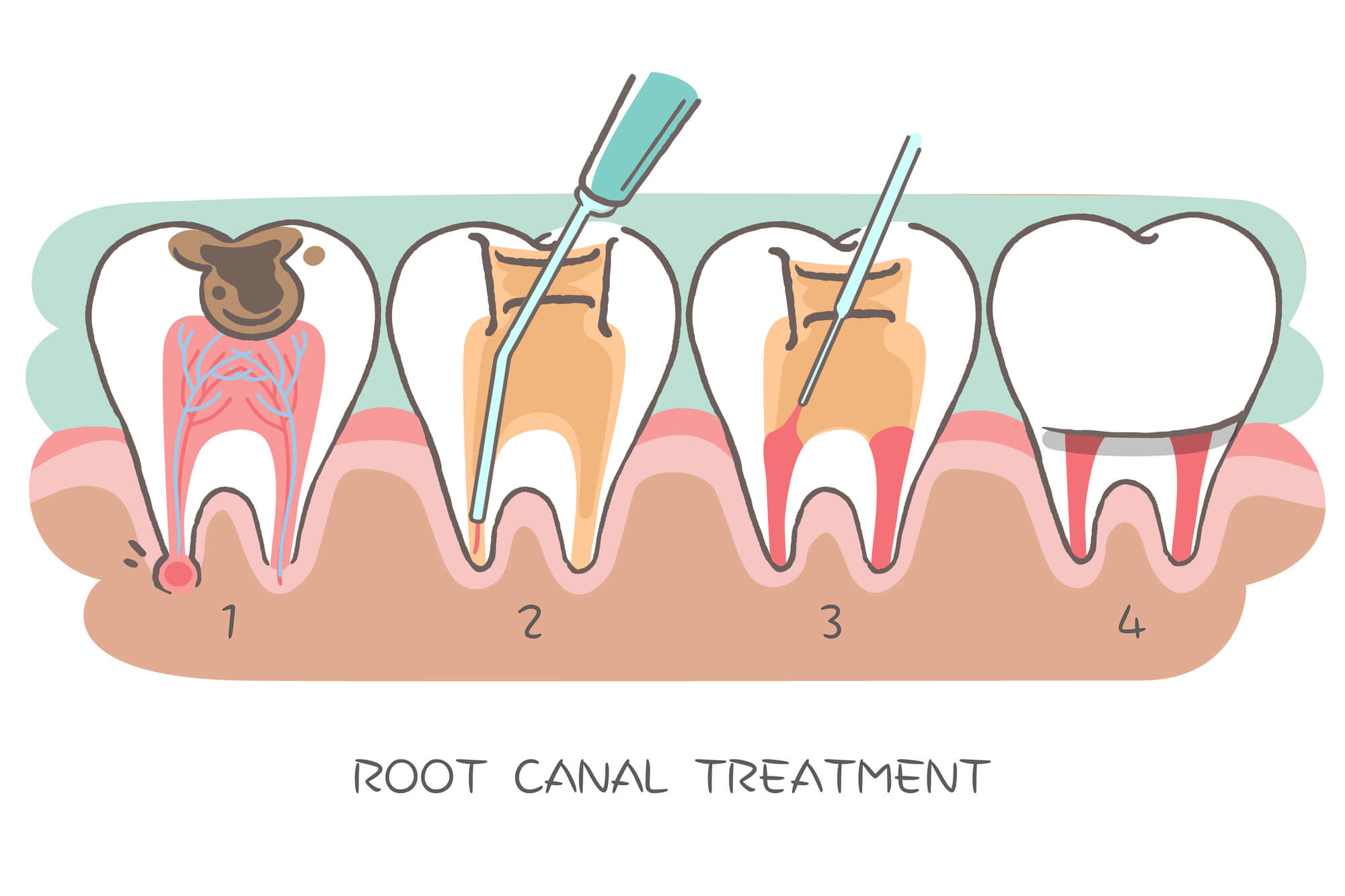 Root Canal in Pompano Beach step by step illustration