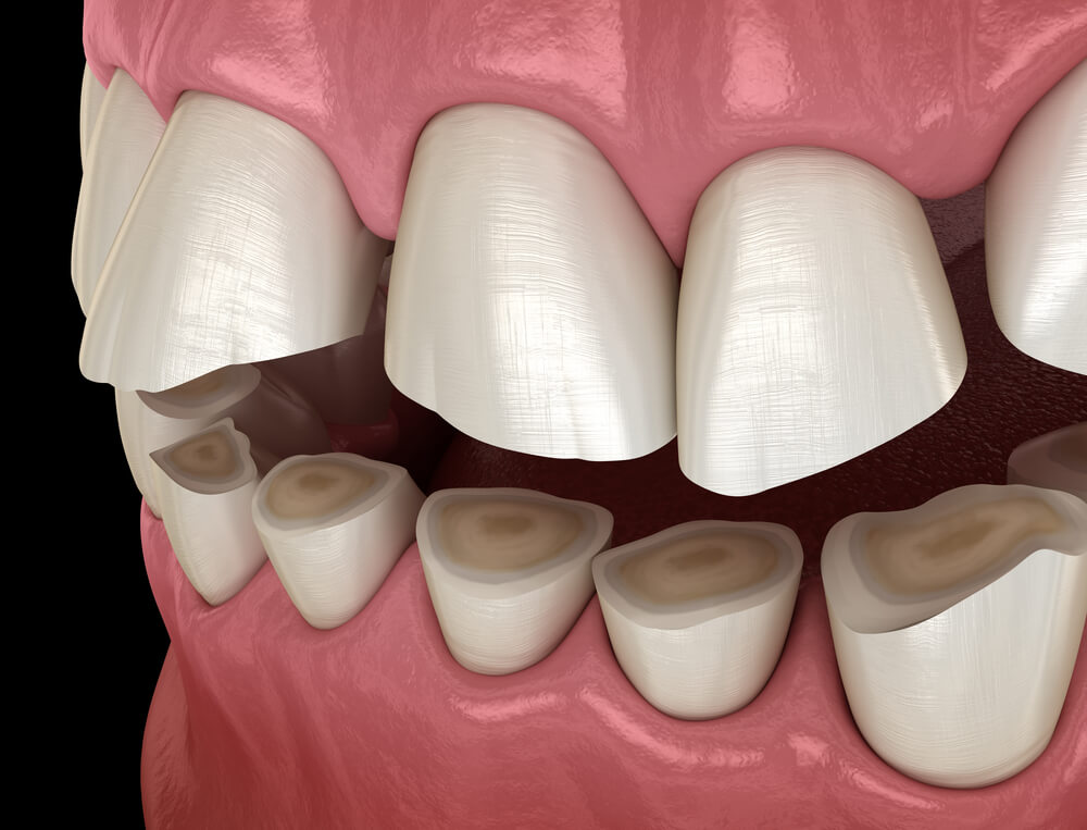 Dentist 33062 with an xray of tooth enamel erosion.