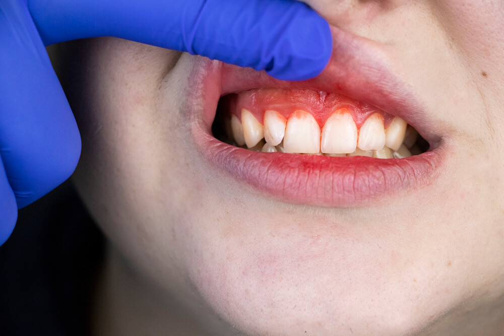 Dentist 33062 with gum disease.