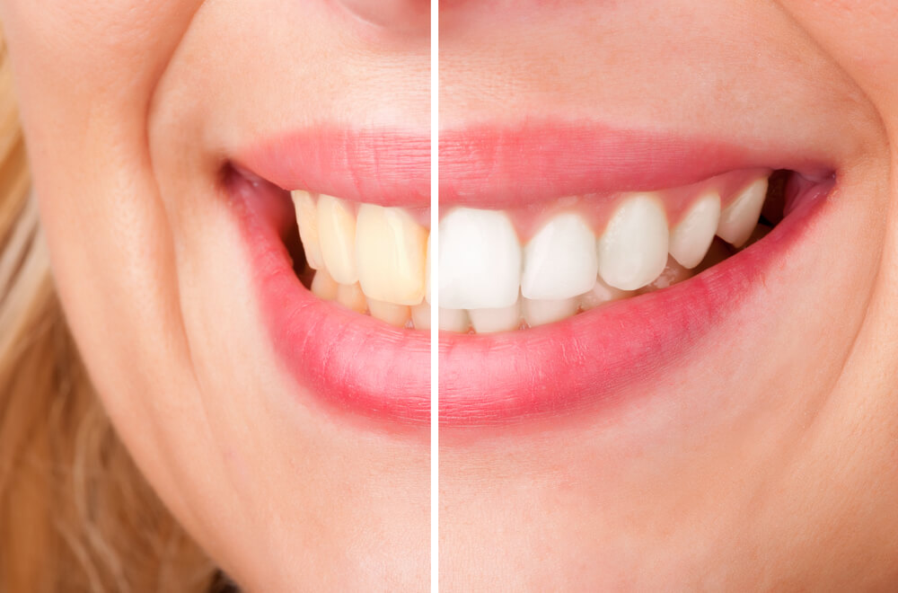 Cosmetic Dentist in Pompano Beach teeth whitening results.