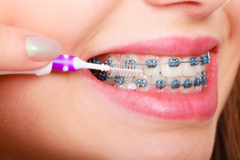 Braces to straighten your teeth with Orthodontist 33062.