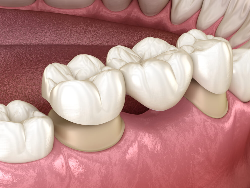 Dental Implants 33062 compared to dental bridges.
