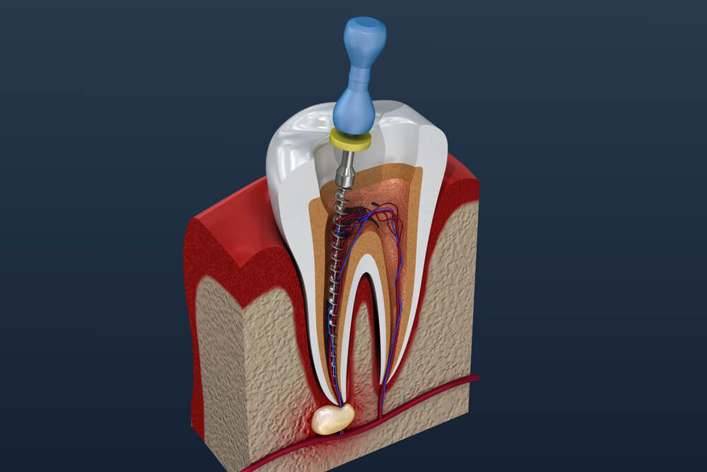 A root canal in Pompano Beach digital image.