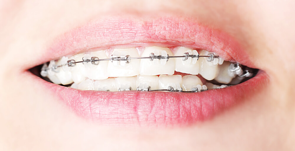 Beautiful braces with Orthodontist 33062