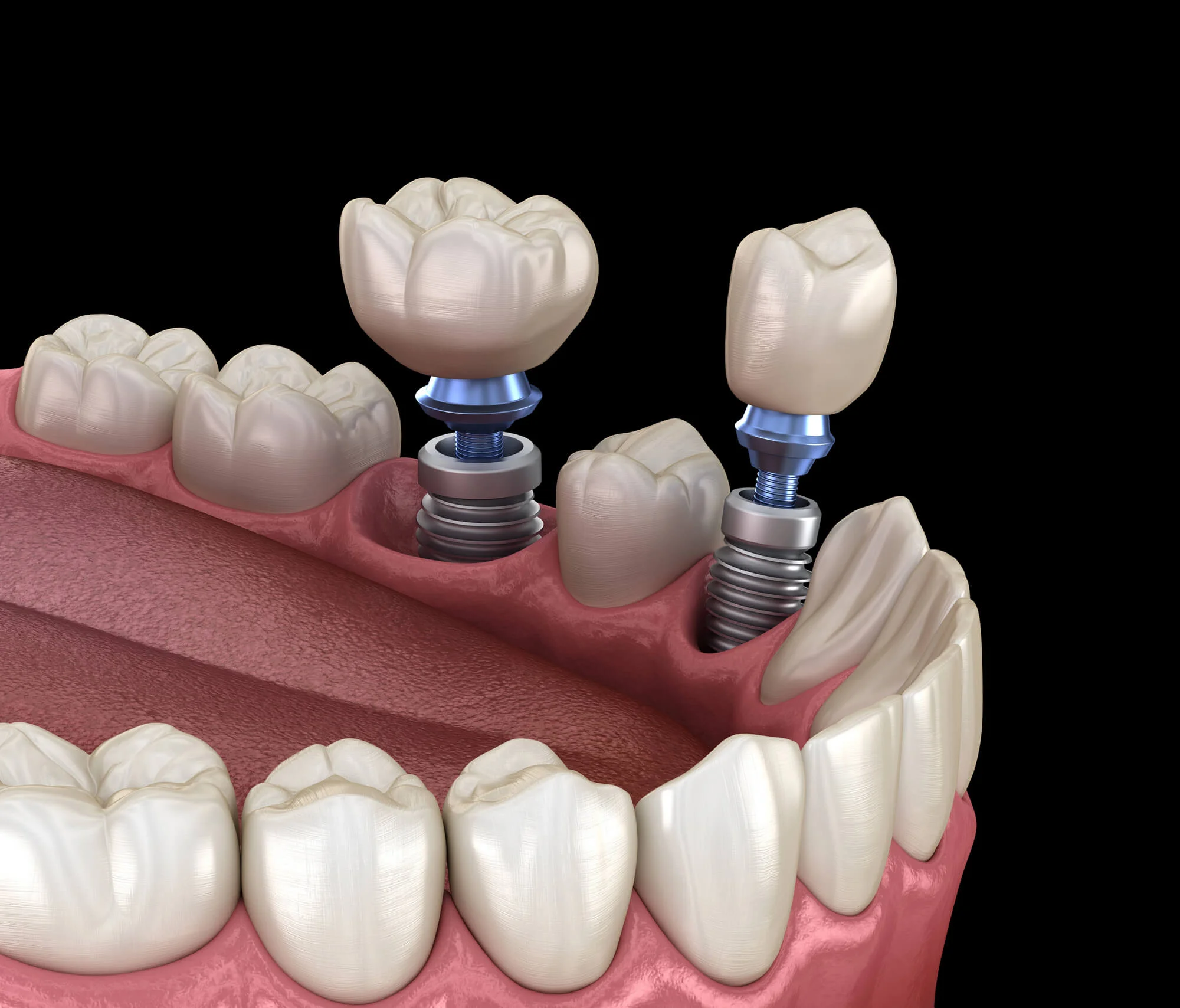 Dental-implant-bridge-example-for-dental-bridges-in-Pompano-Beach